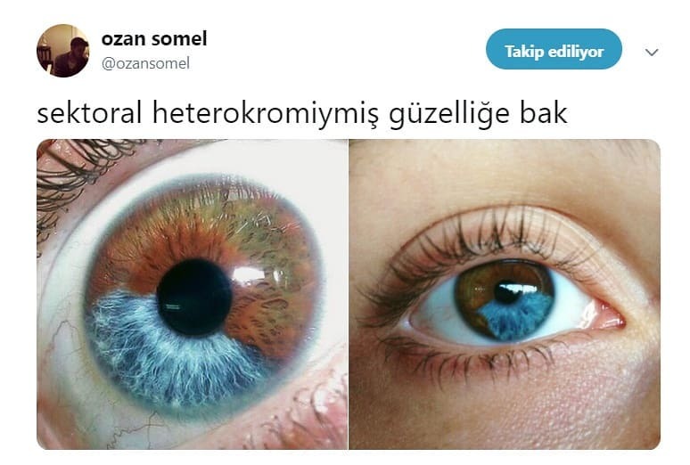 sektoral heterokromiymiş...