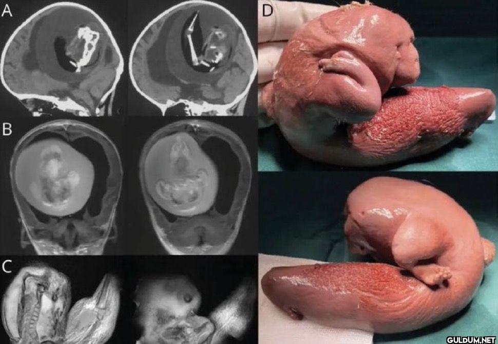 A Fetus was removed from...