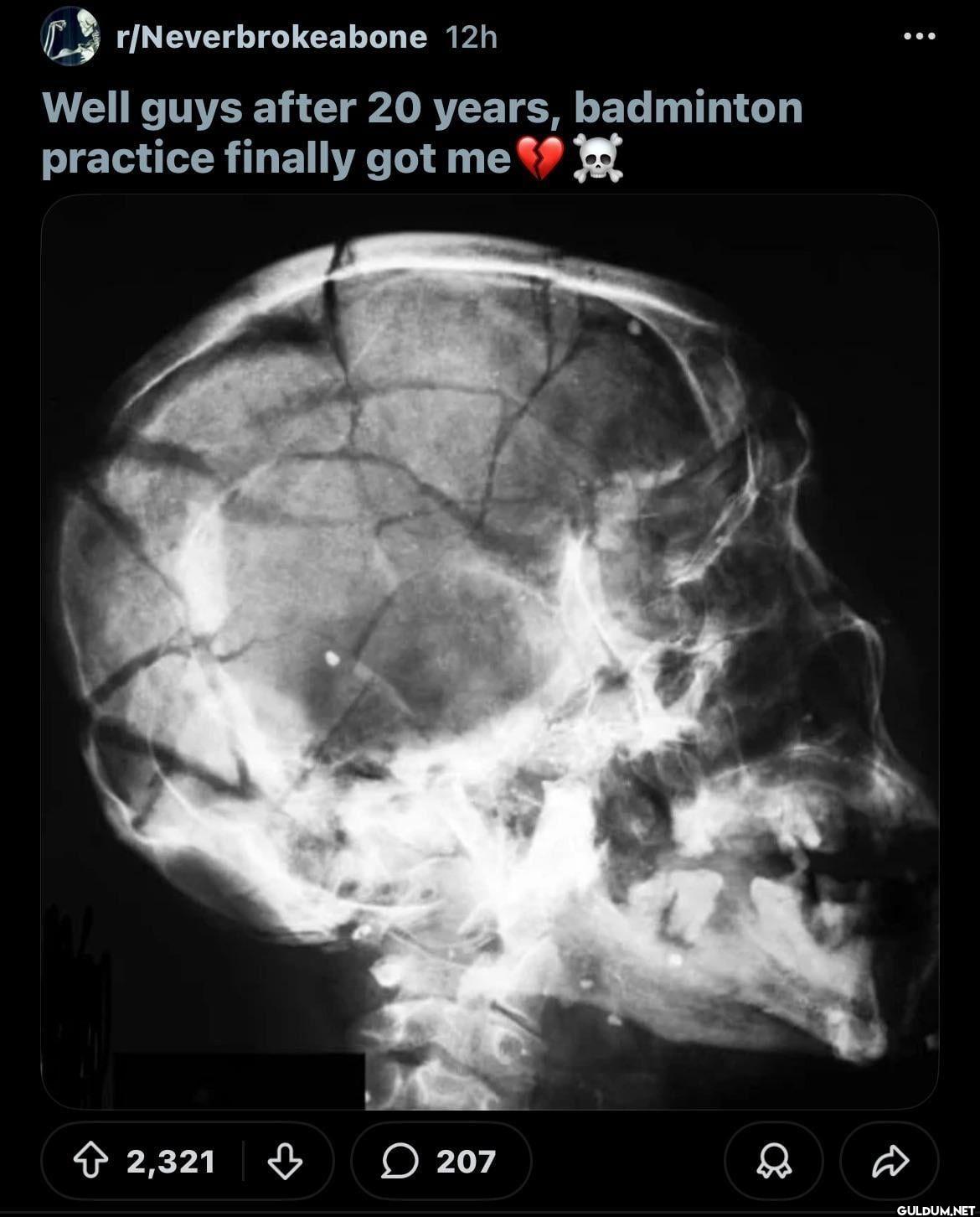 r/Neverbrokeabone 12h Well...