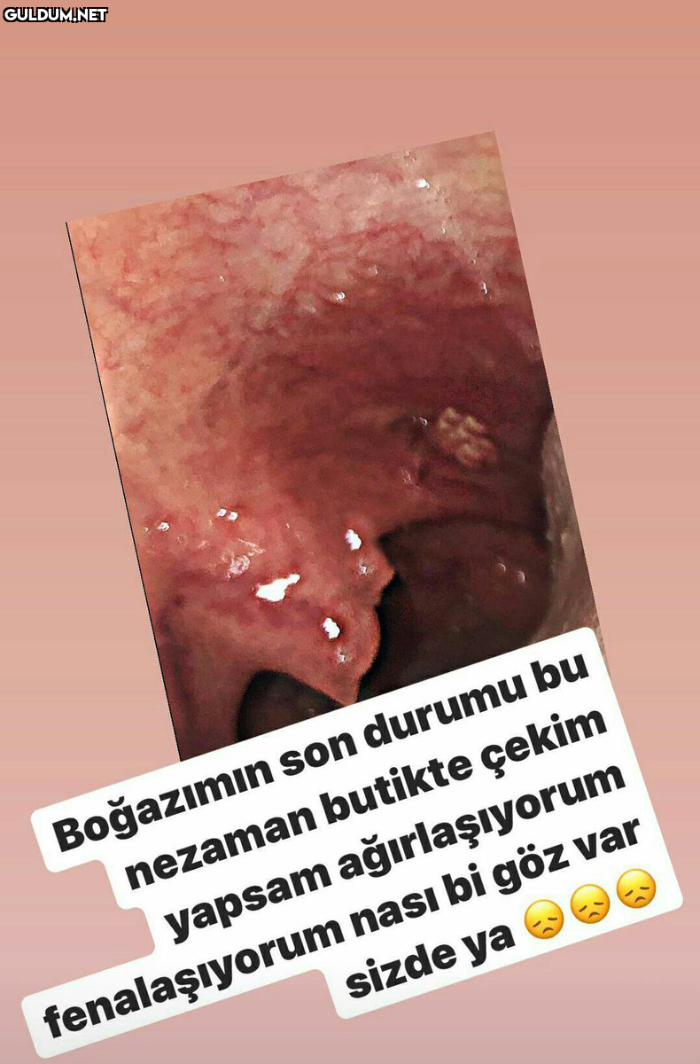 Abla korona olmuşsun ne...