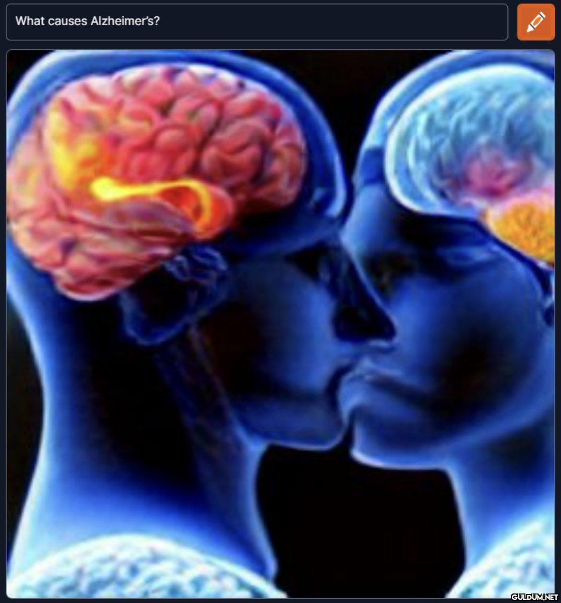 What causes Alzheimer's?   Kaynak