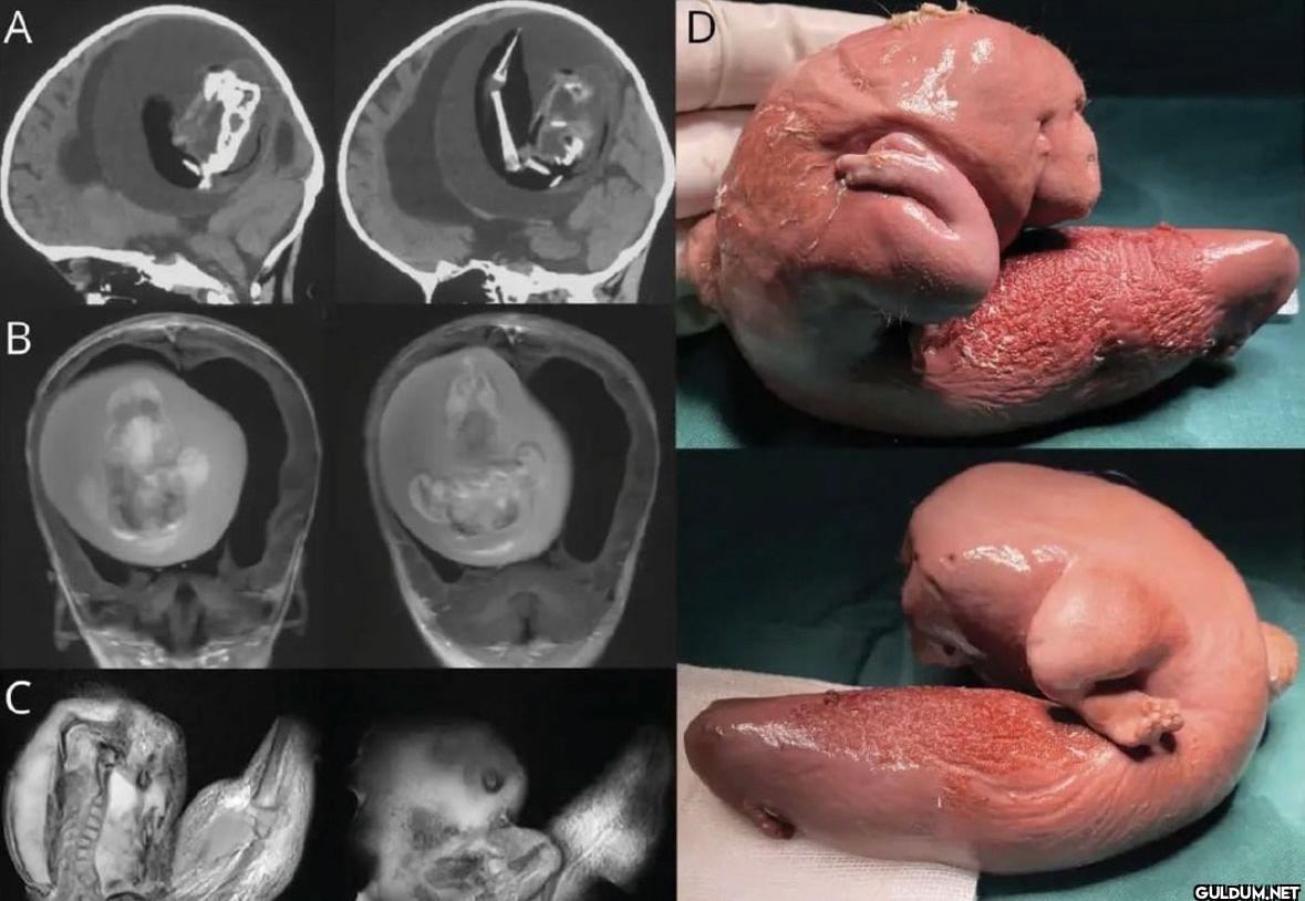 A Fetus was removed from...