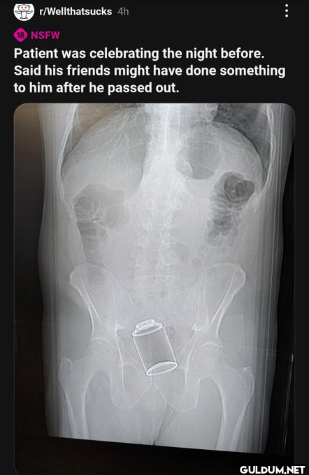 r/Wellthatsucks 4h 18 NSFW...