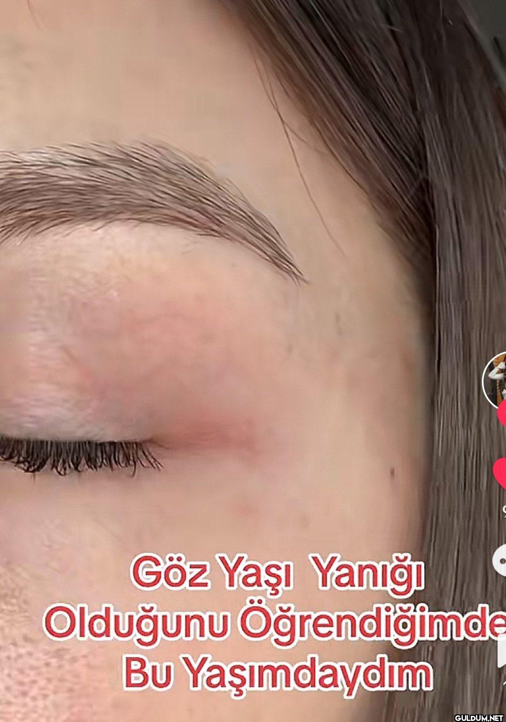 Göz Yaşı Yanığı Olduğunu...