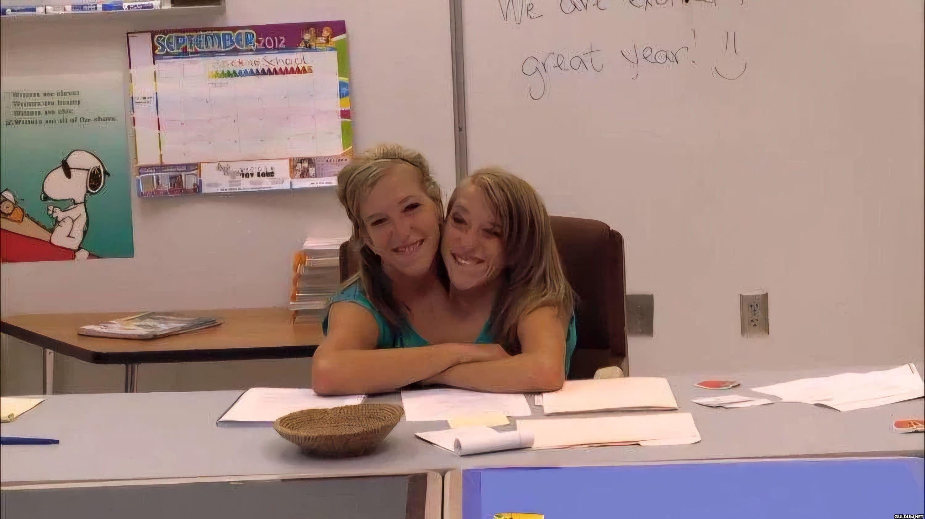 Conjoined twins, Abby and...