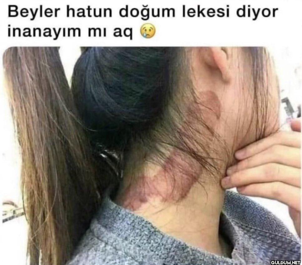 Beyler hatun doğum lekesi...
