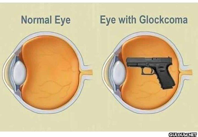 😂😂    Normal Eye Eye with Glockcoma